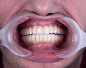 how to fix a gummy smile check