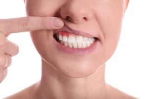 how to fix a gummy smile receding